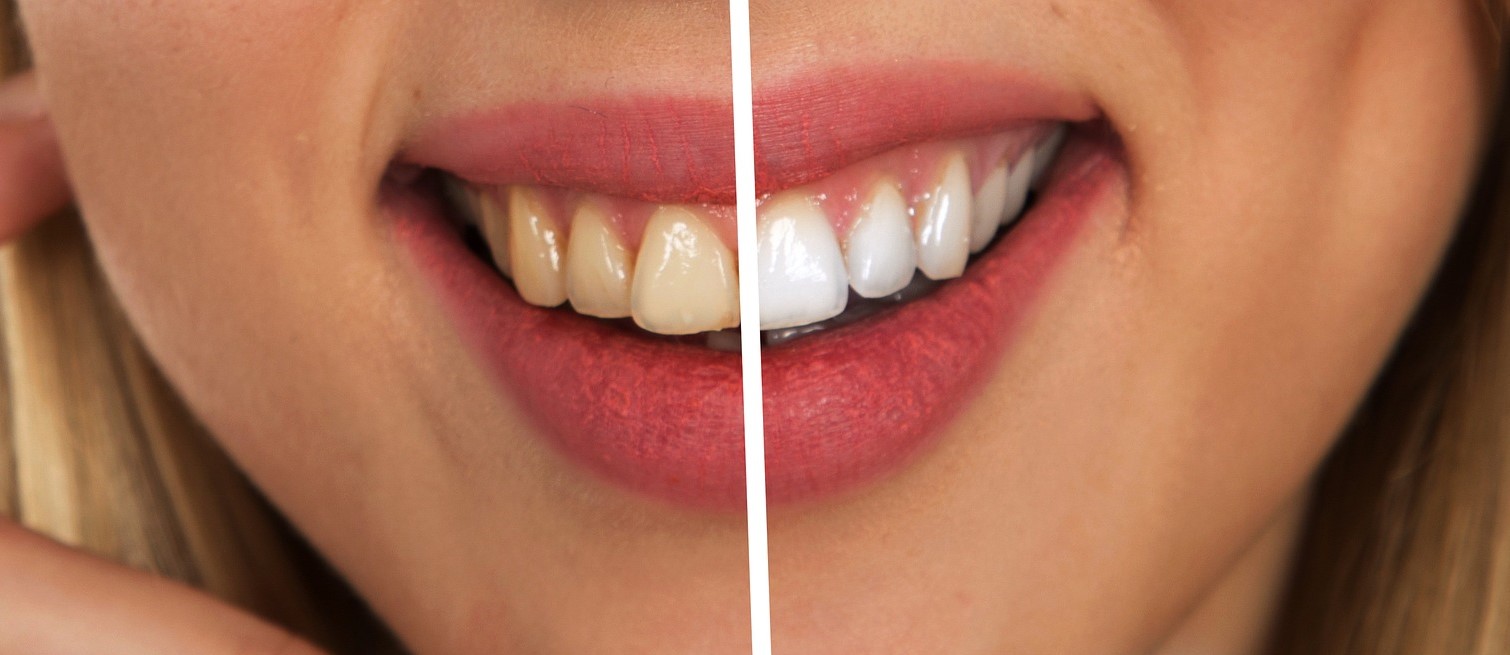 tooth-2414909_1920