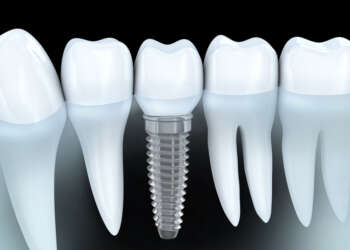Dental-Implants