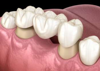 dental bridge crowns dental bridge crowns