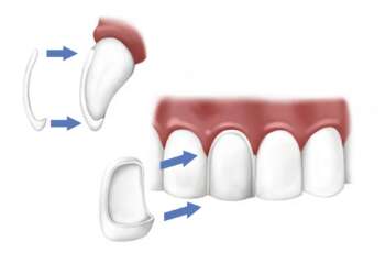 porcelain veneers carillas veneers carillas