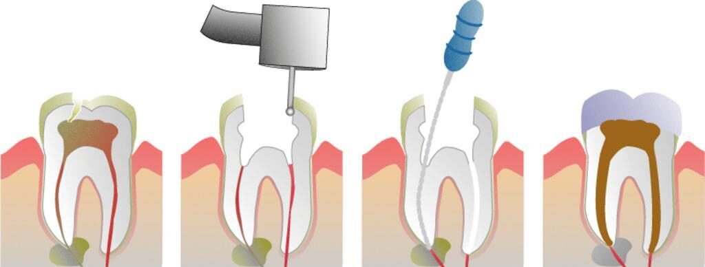 Root Canal Illustration