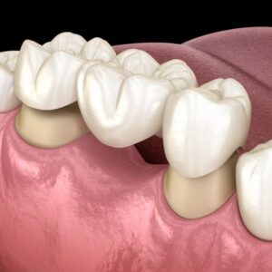 dental bridge crowns