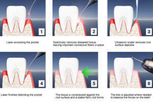 root canal